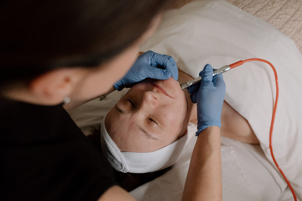 esthetician providing microdermabrasion on a client's face