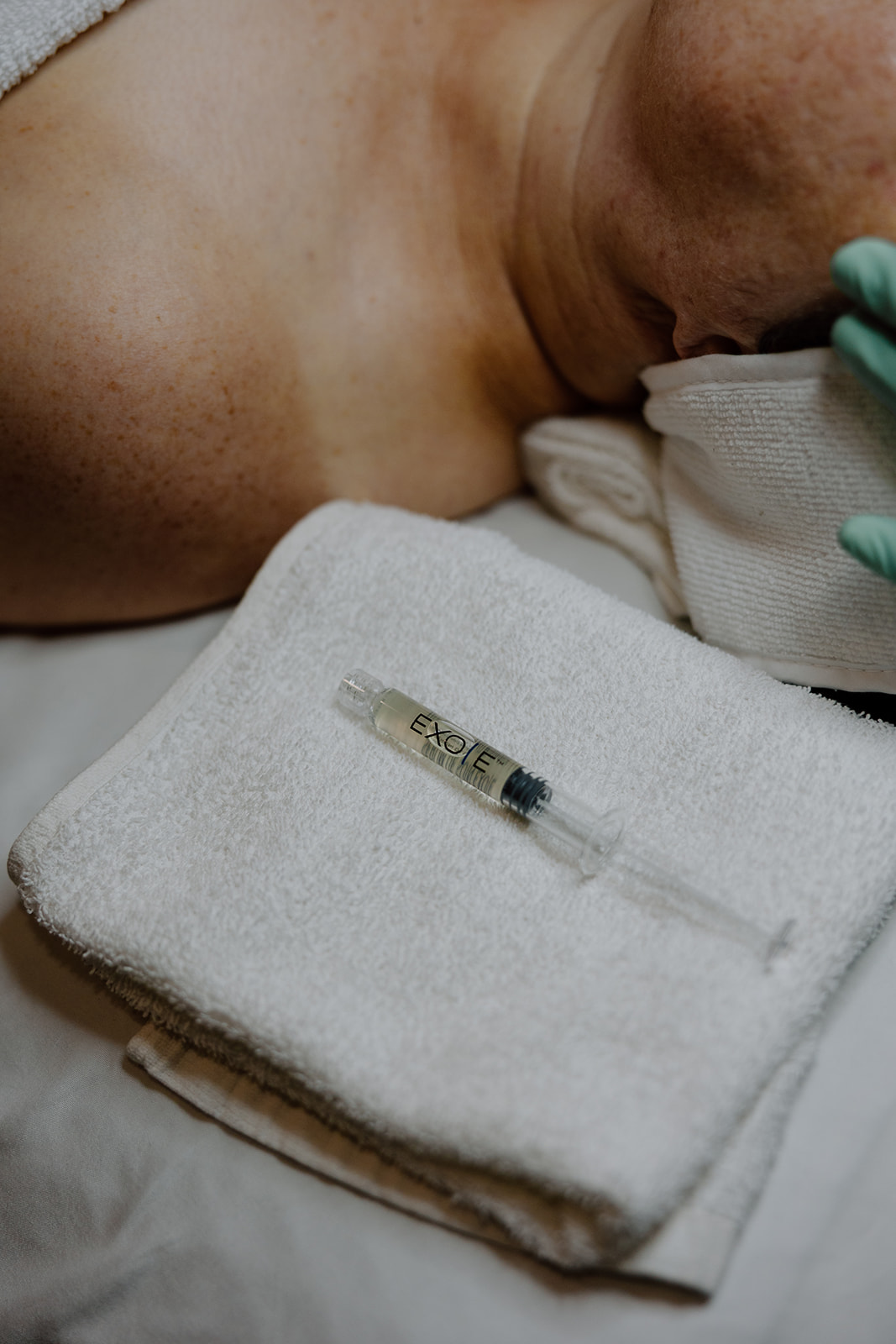 EXO|E serum in a syringe ready to apply is lying on a clean white towel next to a clients shoulder while they await the next step in a microneedling treatment.