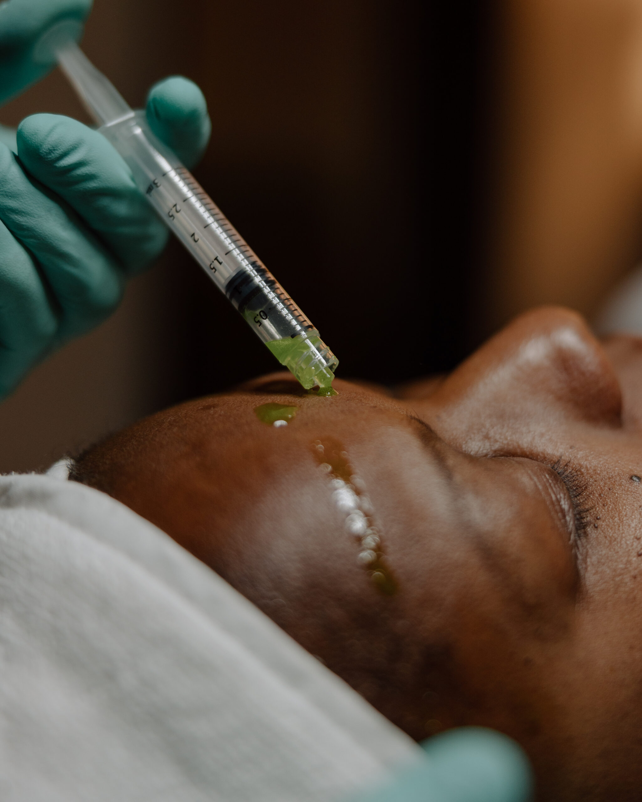 a woman closes her eyes as BioRePeel is applied using a syringe